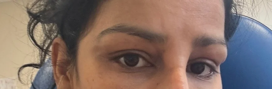 After one week — view 1