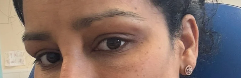 After one week — view 2